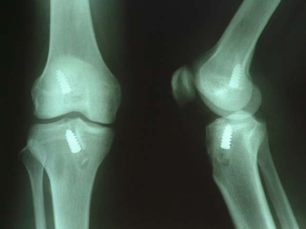 前<em>交叉</em>韧带重建手术