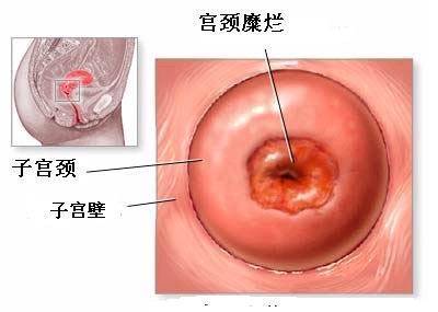 至颈管内的阴道镜图像