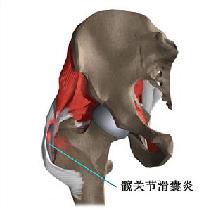 坐骨结节滑囊位置图图片