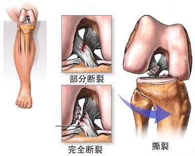 手腕韌帶拉傷