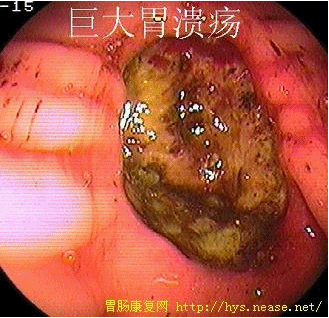 胃溃疡的位置愈高,预后愈坏.贲门下的溃疡穿孔,病死率可达80.